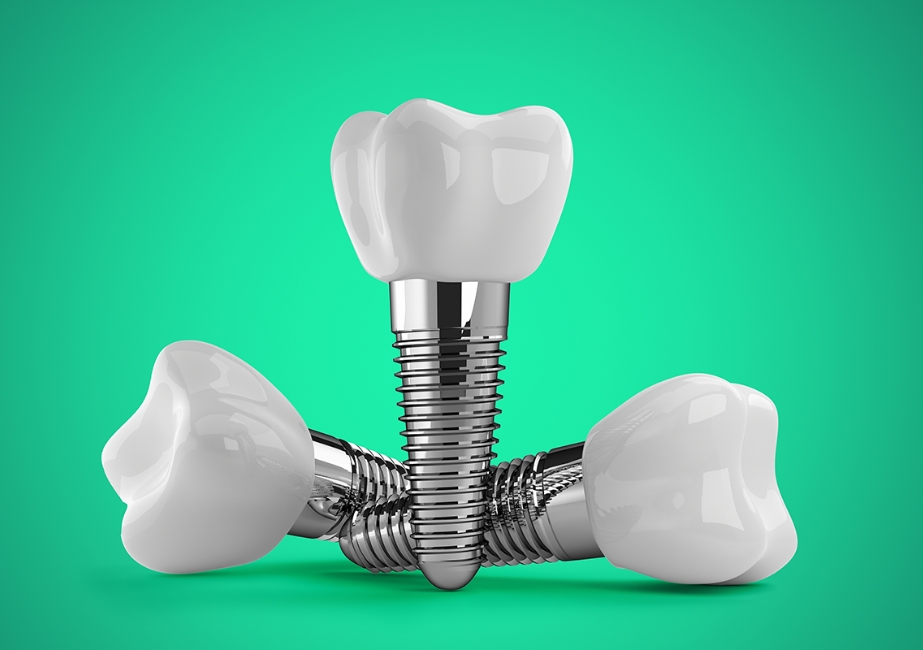 Des implants complets près de chez vous !